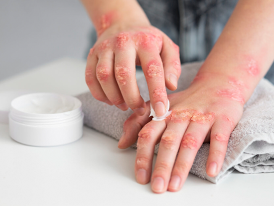 Our skin allergy treatments are designed to alleviate discomfort and prevent future reactions by addressing the root causes of your allergies. Through detailed skin testing, tailored topical treatments, and lifestyle guidance, we work to reduce irritation, redness, and itchiness. With a focus on restoring your skin’s health and resilience, our approach helps you enjoy a life free from the distress of allergic reactions.